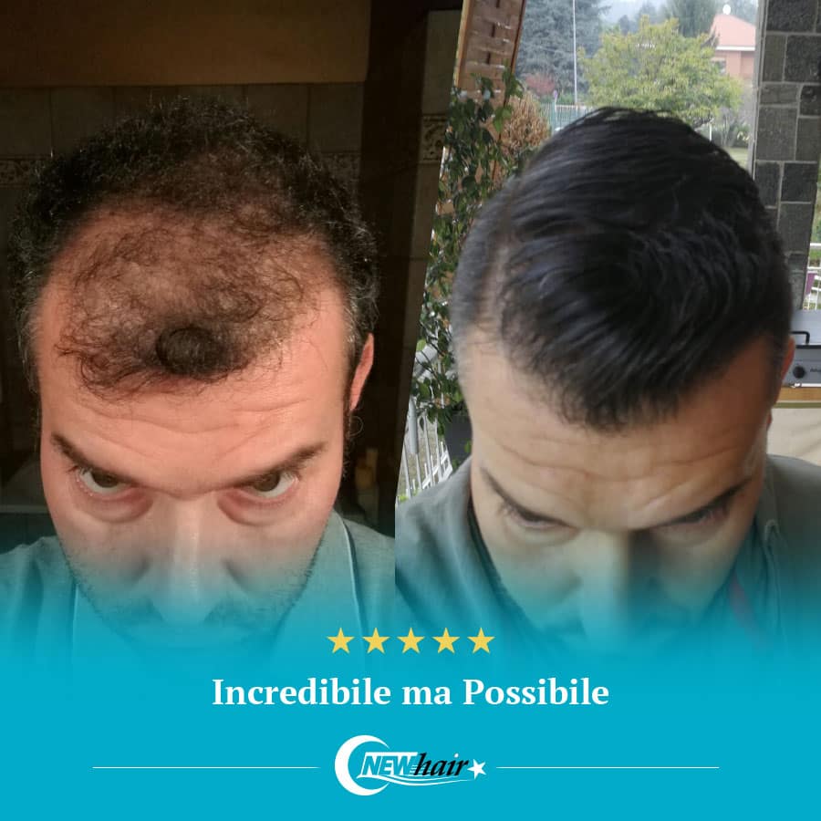 costo trapianto capelli turchia