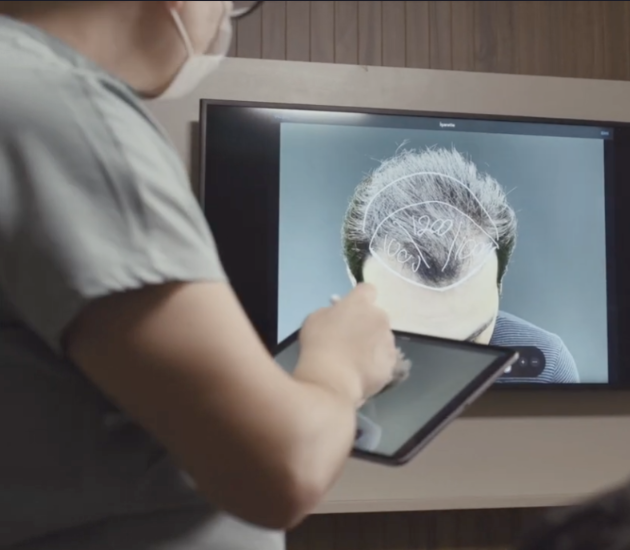 trapianto capelli con tecnica FUE